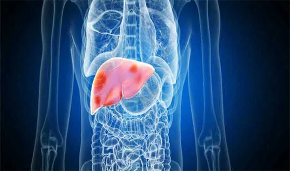 ‘फैटी लीवर की बीमारी भारत में एक महामारी की तरह है’,30 से 40 प्रतिशत आबादी है इससे पीड़ित 