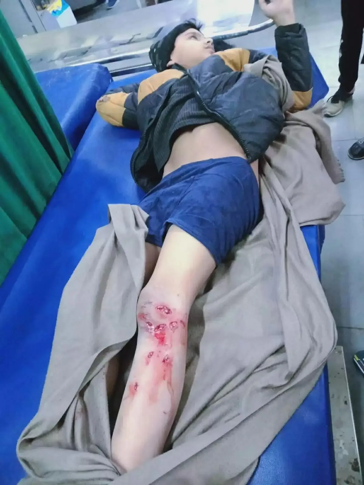 मुज़फ्फरनगर में घरेलू वहशी कुत्ते पिटबुल ने बच्चे को बनाया निशाना, पैर में दस टांके लगे