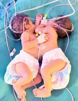 प्रकृति का दुर्लभ करिश्मा! महराजगंज में धड़ से जुड़े जुड़वा बच्चों का जन्म,