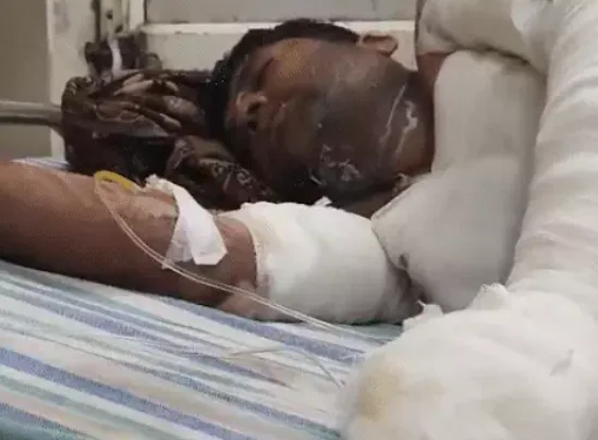 आगरा: शादी से इनकार करने पर प्रेमिका ने प्रेमी को पेट्रोल डालकर जिंदा जलाया, हालत नाजुक