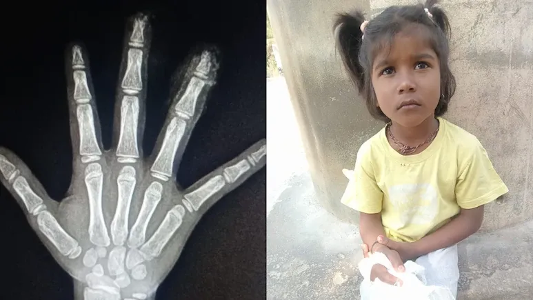 खौफनाक! सरकारी विद्यालय में छह बर्षीय बच्ची की दो उंगलियां कटीं, माता-पिता ने कर्मचारियों पर लगाया लापरवाही का आरोप