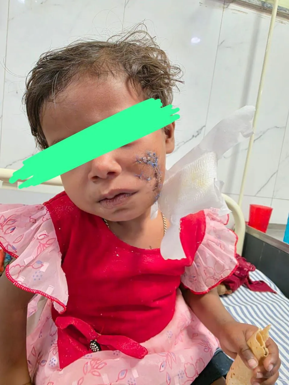 मेरठ में आवारा कुत्तों के हमले में घायल बच्ची सारा की सफल प्लास्टिक सर्जरी