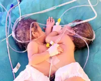 प्रकृति का दुर्लभ करिश्मा! महराजगंज में धड़ से जुड़े जुड़वा बच्चों का जन्म,