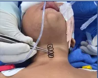 एम्स के डॉक्टरों ने 14 महीने के बच्चे की फूड पाइप से 2 इंच लंबा मेटल स्प्रिंग निकाला