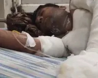 आगरा: शादी से इनकार करने पर प्रेमिका ने प्रेमी को पेट्रोल डालकर जिंदा जलाया, हालत नाजुक