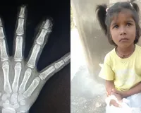 खौफनाक! सरकारी विद्यालय में छह बर्षीय बच्ची की दो उंगलियां कटीं, माता-पिता ने कर्मचारियों पर लगाया लापरवाही का आरोप