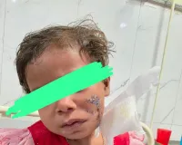 मेरठ में आवारा कुत्तों के हमले में घायल बच्ची सारा की सफल प्लास्टिक सर्जरी