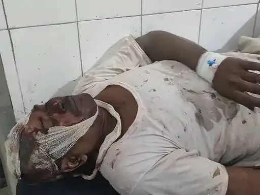 सीतापुर में बेटे ने पिता के सिर पर पत्थर मारा, हालत नाजुक, बेटी को अधिक प्यार देने पर हुआ विवाद