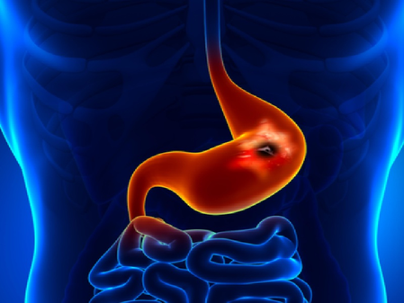 चुपचाप पैर पसारती है ये आंत से जुड़ी बीमारी, लक्षणों को न करें अनदेखा 