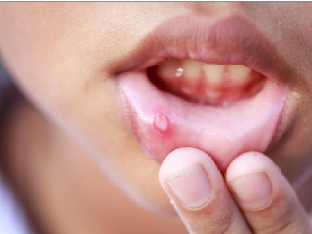 शरीर में पित्त बढ़ने का संकेत है बार-बार मुंह में हो रहे छाले, अनदेखा करना पड़ सकता है भारी 