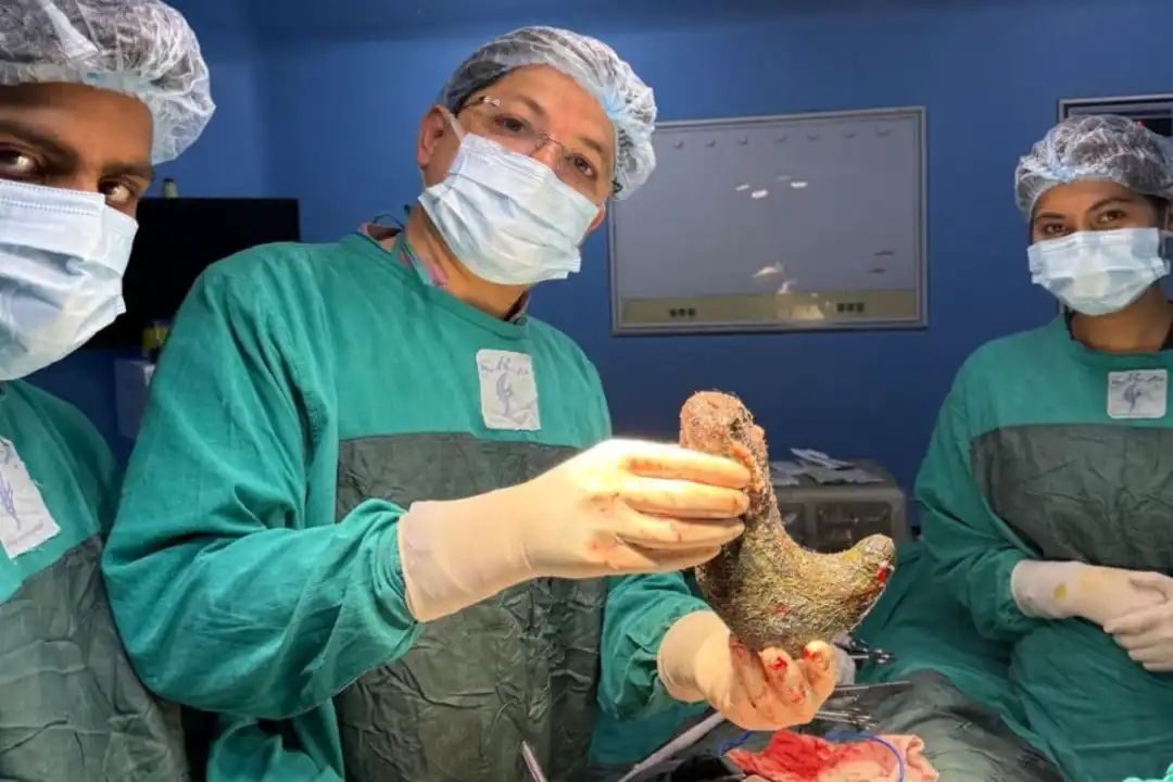 बिहार : ऑपरेशन के दौरान महिला के पेट से निकला डेढ किलो बालों का गुच्छा