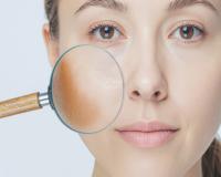 शरीर में विटामिन्स की कमी का संकेत है झाईयां, इन आयुर्वेदिक उपायों से मिल सकती है राहत