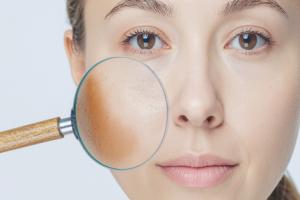 शरीर में विटामिन्स की कमी का संकेत है झाईयां, इन आयुर्वेदिक उपायों से मिल सकती है राहत