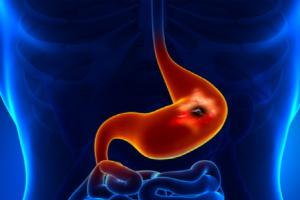 चुपचाप पैर पसारती है ये आंत से जुड़ी बीमारी, लक्षणों को न करें अनदेखा 